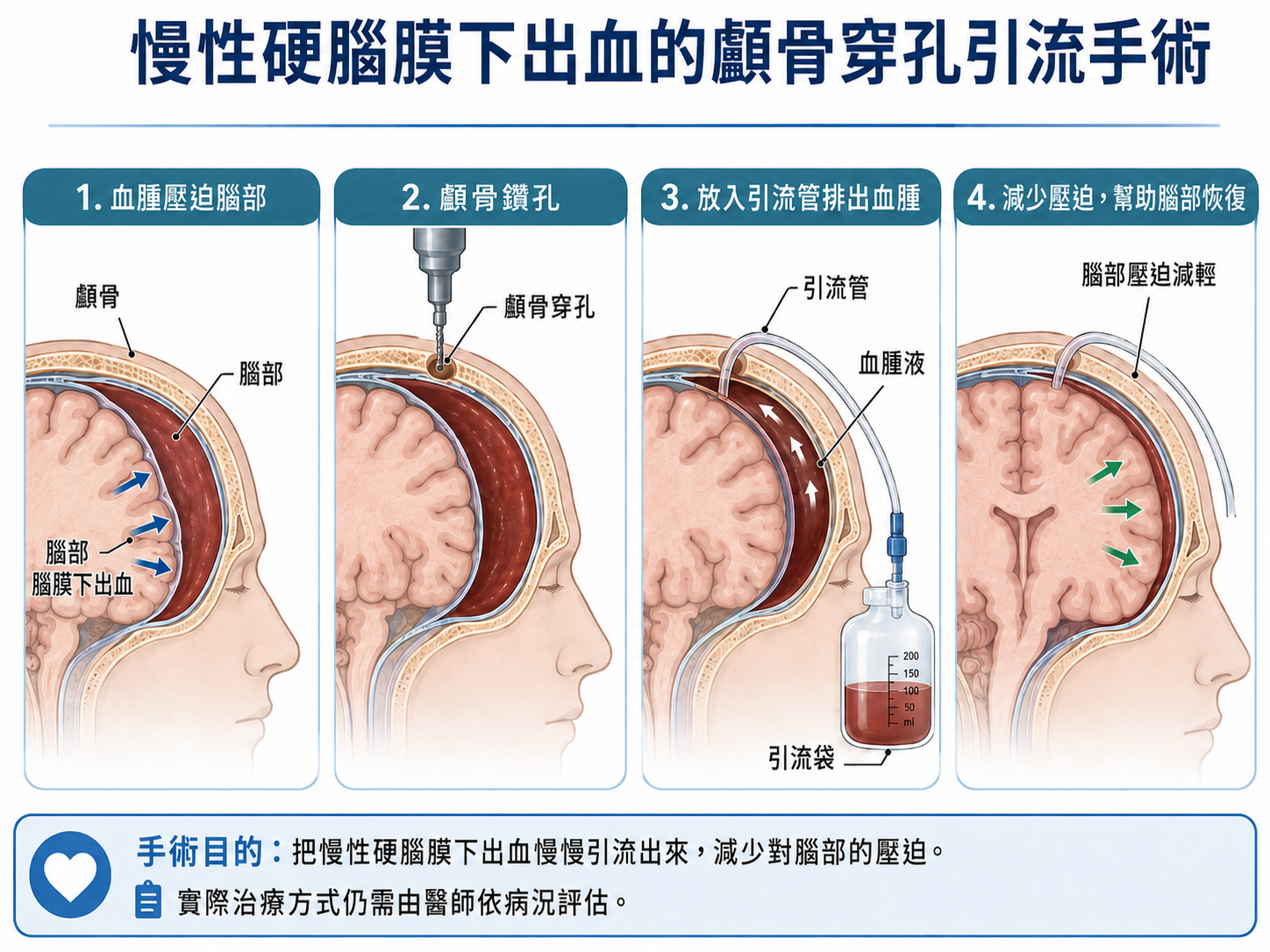 慢性硬腦膜下出血顱骨鑽孔引流手術示意圖